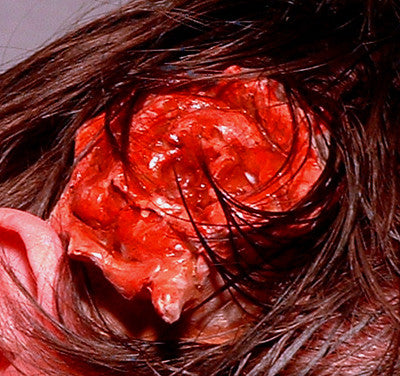 Head Wound